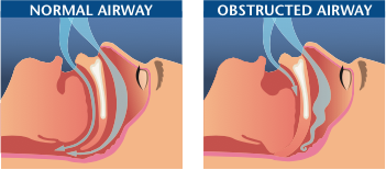 normal and obstructed airways - sleep apnea