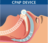 airway with cpap device - sleep apnea